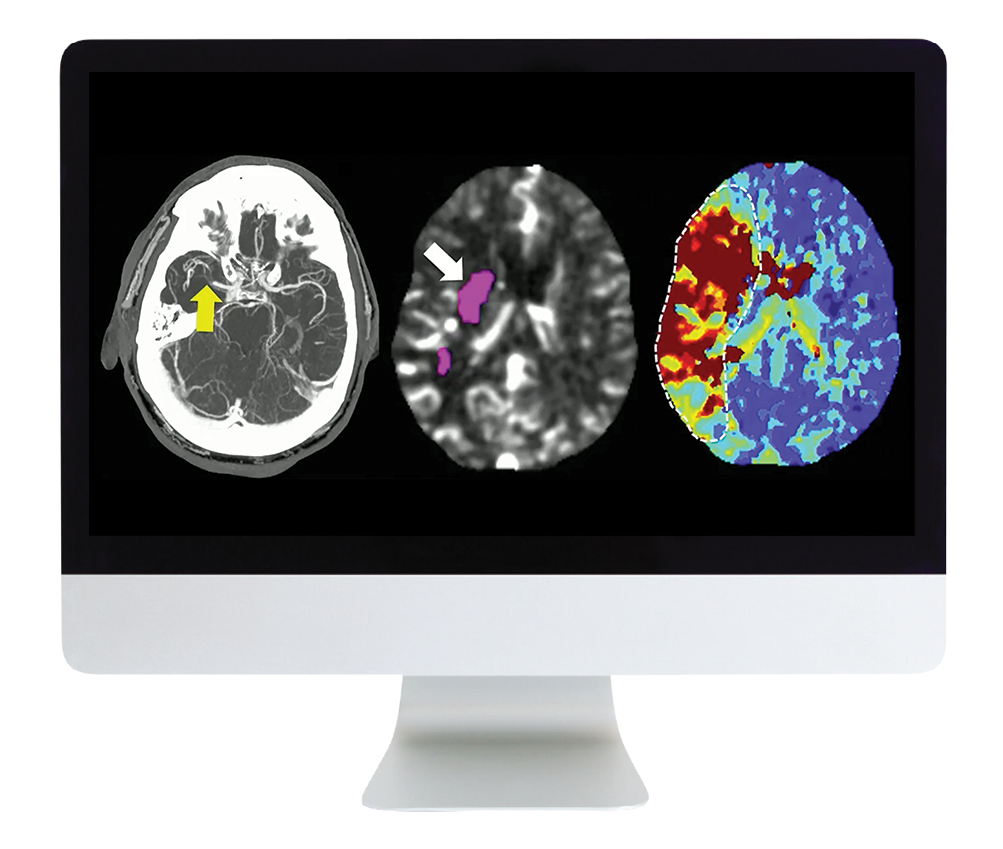 ARRS Code Stroke: What Every Radiologist Should Know 2022