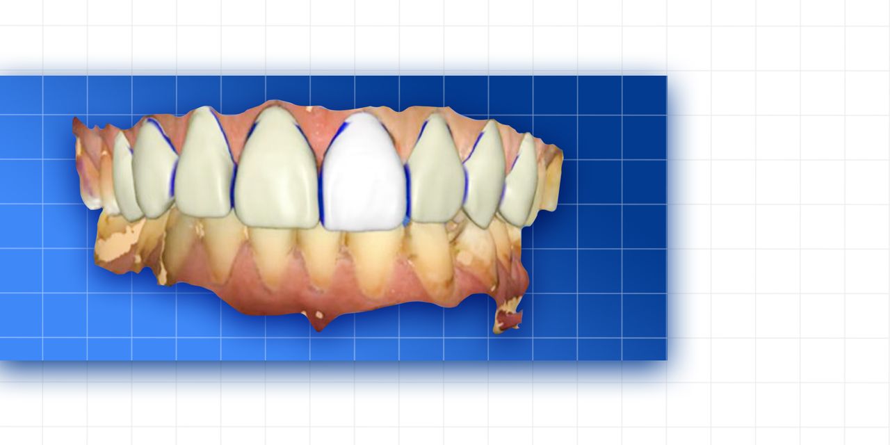 OHI-S Complete prosthetic protocols CADCAM CEREC