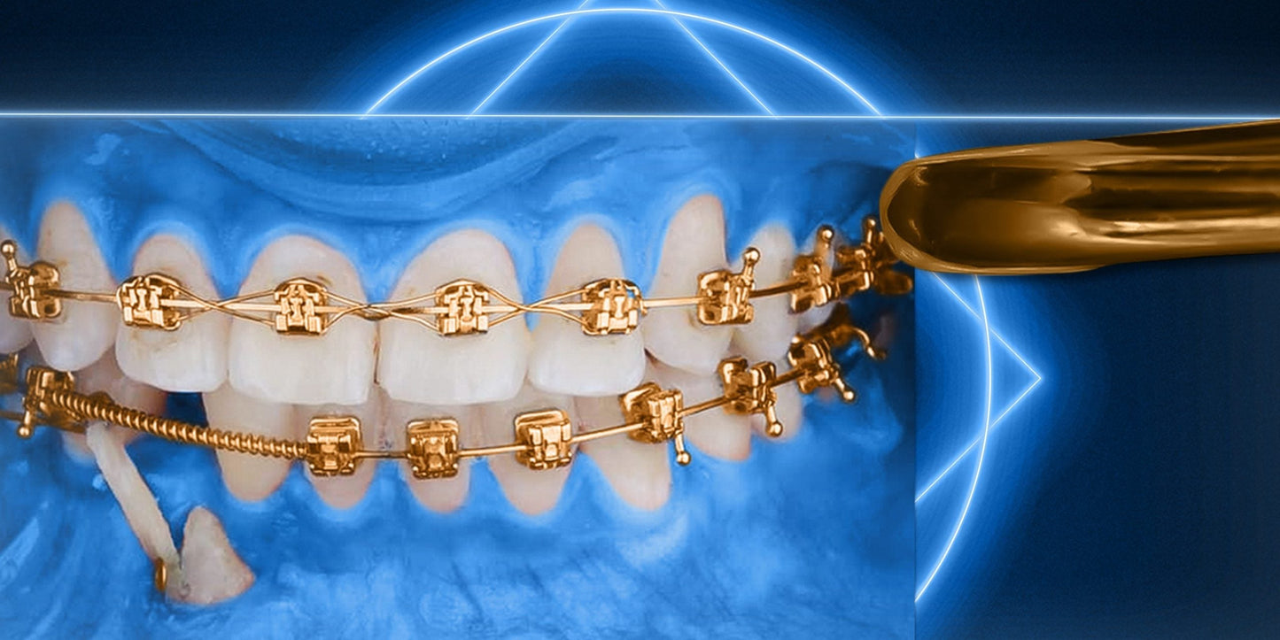 OHI-S Impaction Treatment Author’s Protocols, Mistakes and Solutions