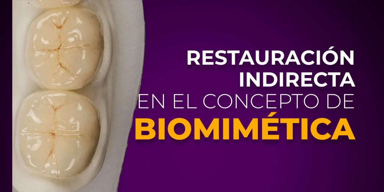 OHI-S Restauración indirecta en el concepto de biomimética Spanish
