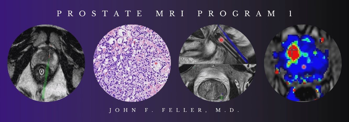 2021 Prostate MRI (Program 1) – John F. Feller, M.D