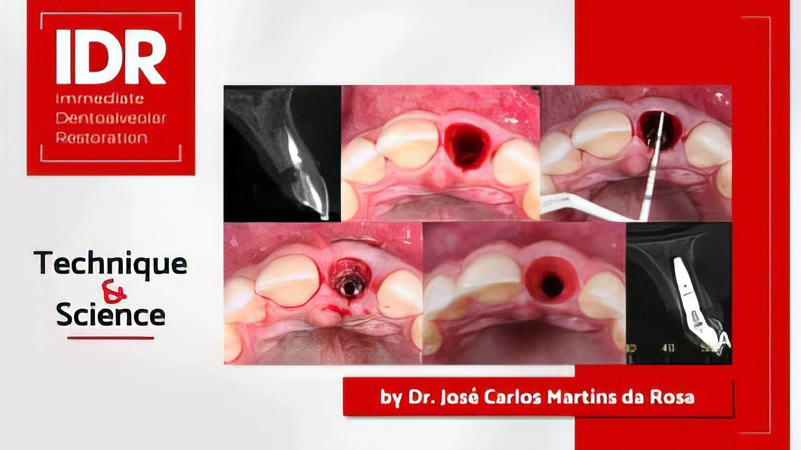 pikos-institute-immediate-dentoalveolar-restoration