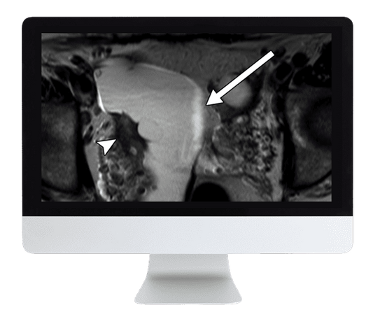 ARRS Pitfalls in GI Imaging 2022