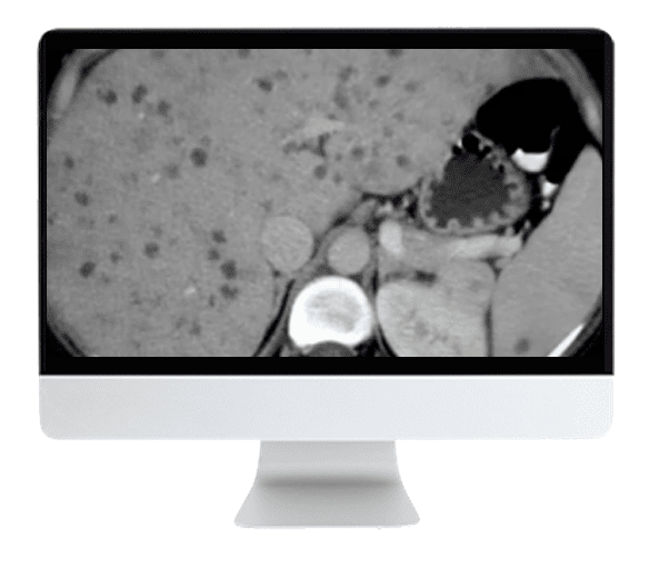 ARRS State of the Art Liver Imaging in Cirrhosis 2021 ( VIDEOS)
