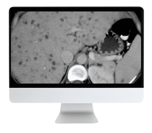 ARRS State of the Art Liver Imaging in Cirrhosis 2021 ( VIDEOS)