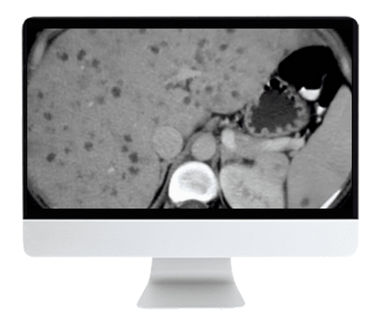 ARRS State of the Art Liver Imaging in Cirrhosis 2021 ( VIDEOS)