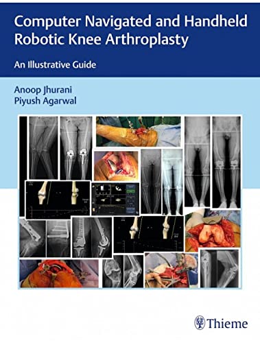 Computer Navigated and Handheld Robotic Knee Arthroplasty: An Illustrative Guide (Original PDF from Publisher)