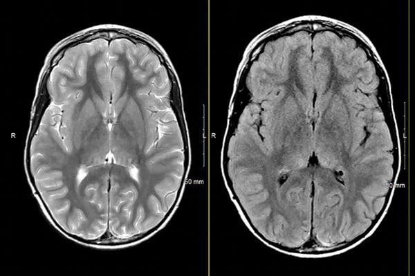 MRIOnline Mastery Series: Neurofibromatosis Type 1 (NF1) 2021