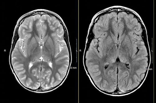 MRIOnline Mastery Series: Neurofibromatosis Type 1 (NF1) 2021