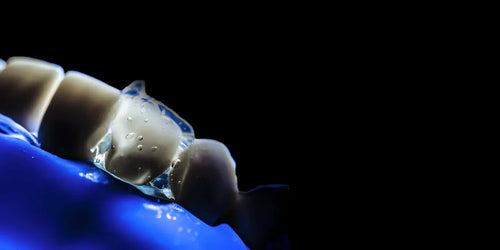 OHI-S Occlusion-driven stress-reduced direct composite (SRDC)