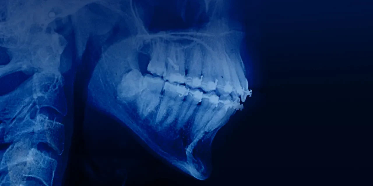 OHI-S Orthodontic treatment in patients with periodontal and alveolar bone pathology