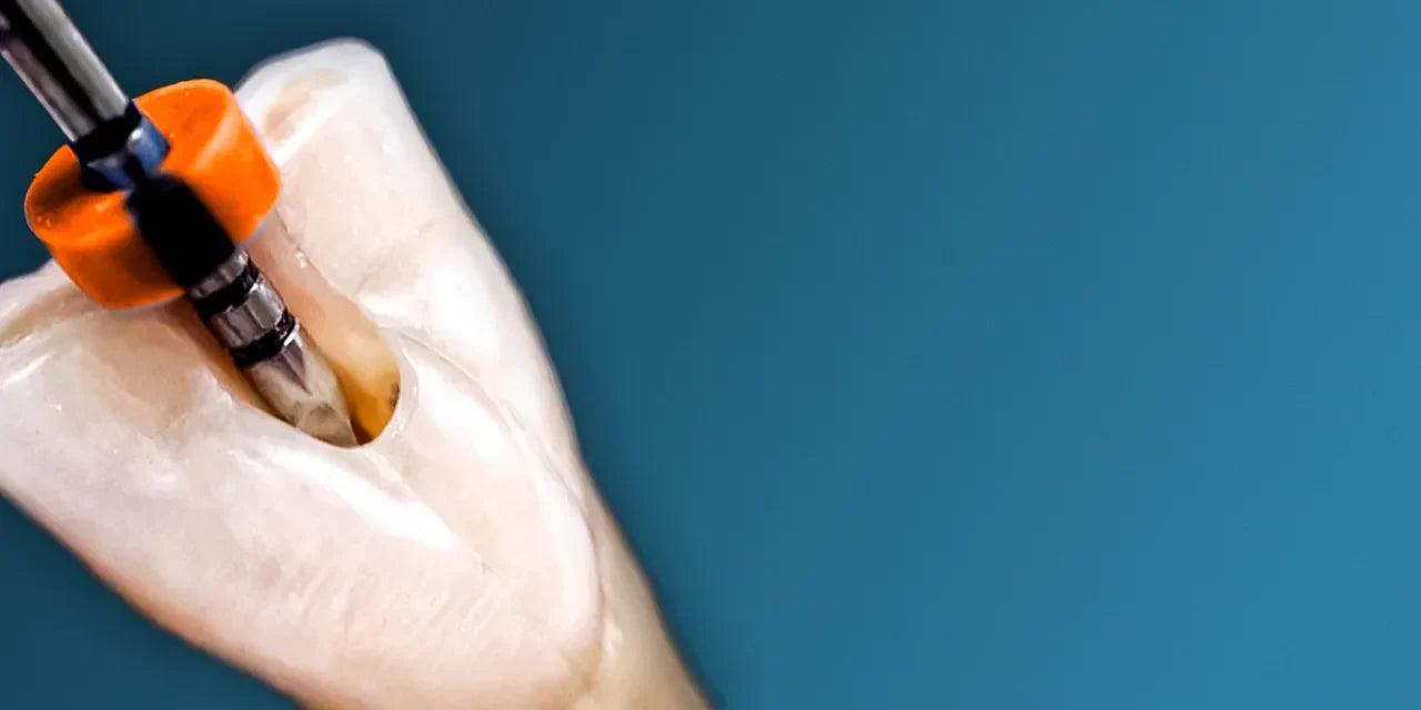 OHI-S Root perforations – diagnosis and treatment