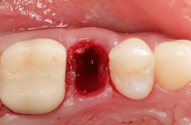 Gidedental Extraction Socket – Preservation/Grafting; Immediate vs Delayed Implants; Pontic Site Development 2020