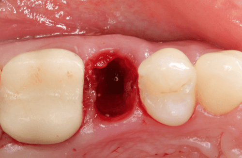 Gidedental Extraction Socket – Preservation/Grafting; Immediate vs Delayed Implants; Pontic Site Development 2020