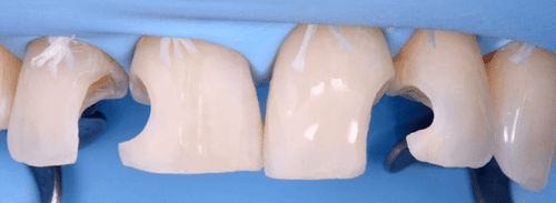 Gidedental Direct and Indirect Adhesive Restorations – Minimal Invasive Treatment of the Anterior and Posterior Damaged Dentition using Direct Bonded Restorations 2020
