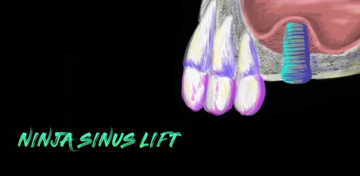 Ninja Sinus Lift Course