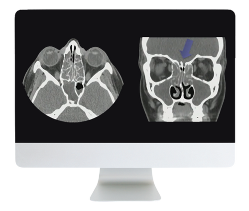 ARRS Cranial Nerve Imaging: From the Least to the Last 2022 ( Videos + CME Questions)