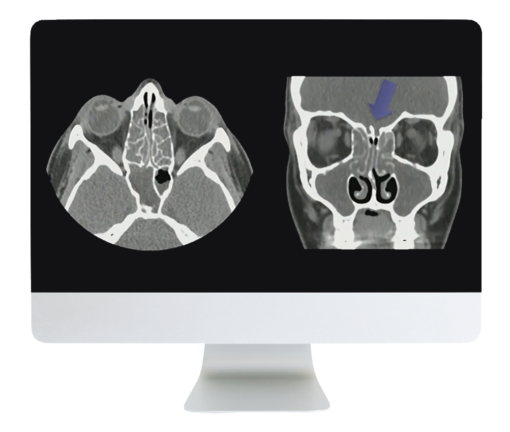 ARRS Cranial Nerve Imaging: From the Least to the Last 2022 ( Videos + CME Questions)